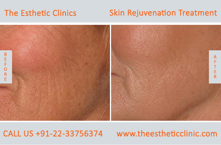 Skin Rejuvenation whitening lightening Laser Treatment before after photos in mumbai india (3)